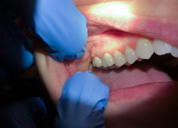 Best Emergency Tooth Extraction in Lexington, VA