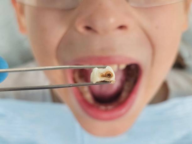 Best Emergency Tooth Extraction in Lexington, VA